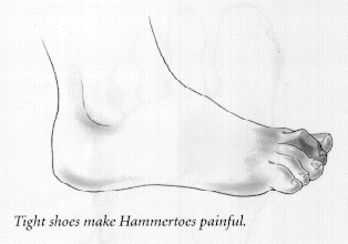 Picture of a Hammer Toe